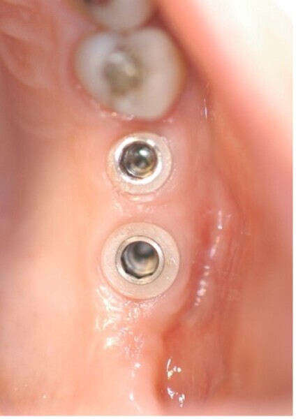 Fig. 10 : Implant hybride (TBR dental implant Z1 infinity) alliant l’avantage des propriétés biomécanique du titane et les propriétés biologiques de la zircone, notamment dans la zone cervicale pour protéger le corps de l’implant des attaques bio-corrosives du milieu buccal.