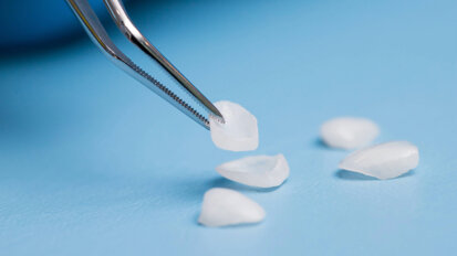 Six-year follow-up highlights durability of veneers in a complex aesthetic case