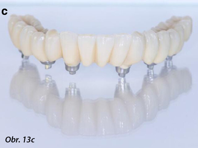 Chromkobaltová základní konstrukce vyrobená pomocí CAD/CAM jako jeden celek před (a, b) a po fazetování kompozitem (SR Nexco Paste, Ivoclar Vivadent), tedy hotovou definitivní fixní náhradu (c, d).