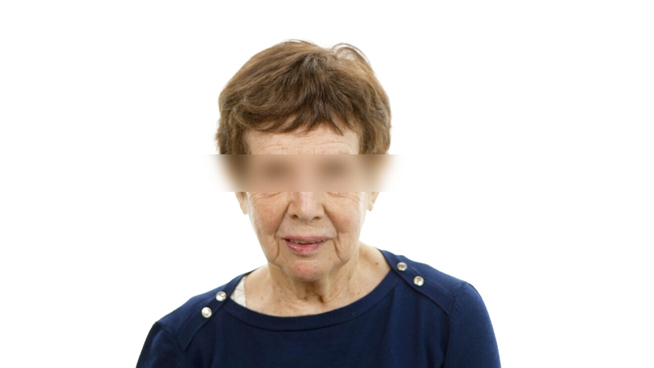 Fig. 1 : Photo de visage de la patiente avec une lèvre inférieure rentrée par l’absence de soutien dentaire.