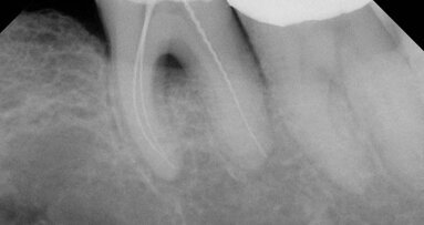 An endodontic absurdity