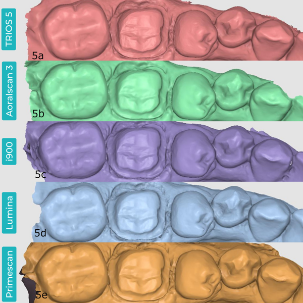 Figs. 5a–e: Scans in STL format previewed in the Medit Design app. TRIOS 5 (a). Aoralscan 3 (b). Medit i900 (c). ITero Lumina (d). CEREC Primescan (e).