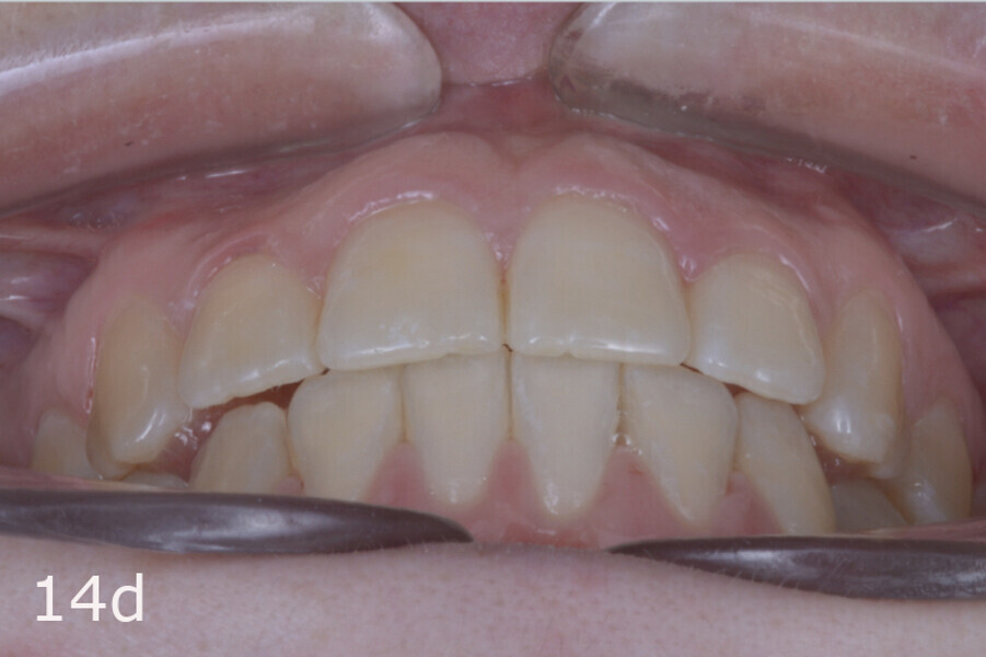 Figs. 14a–h: Intra-oral comparison of the situation (a, d, e & h) before and (b, c, f & g) after treatment.