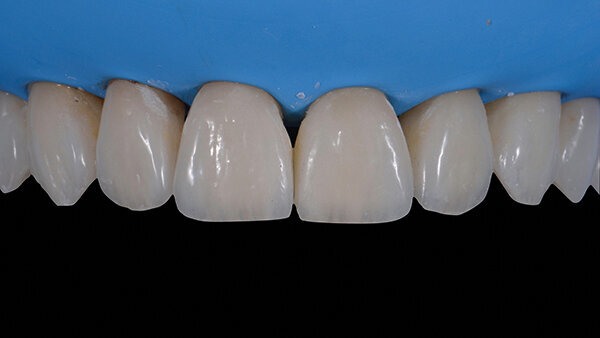 Fig. 16e. Carillas in situ antes del acabado y pulido.