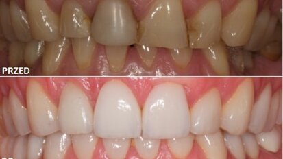 Regeneracja kości i pokrycie recesji w leczeniu estetyczno-implantologicznym