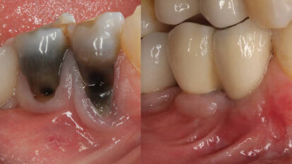 A surgical approach to the management of periapical implant lesions