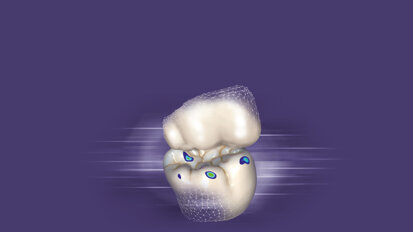 Reduce design time with exocad’s DentalCAD 3.1 Rijeka software