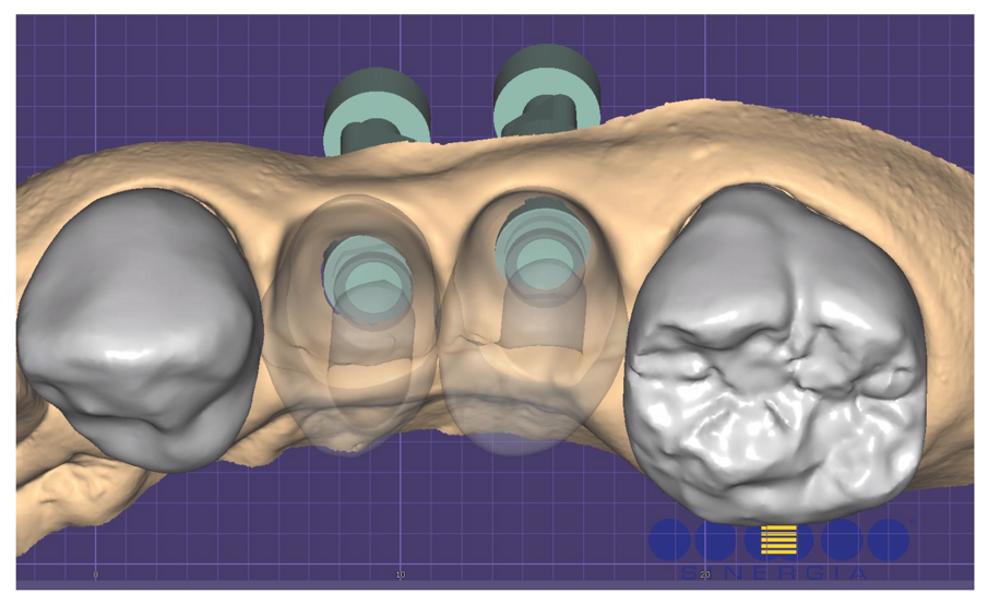 Fig. 9_File CAD di lavoro con in trasparenza le anatomie dei provvisori.