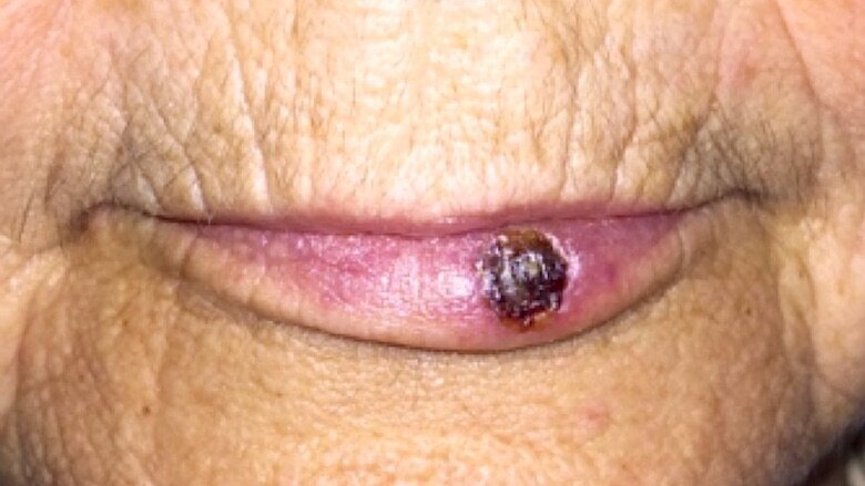 Fig. 3. Aspecto de la lesión inmediatamente después del tratamiento.
