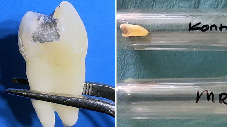 High-strength MRI may cause mercury release from amalgam dental fillings