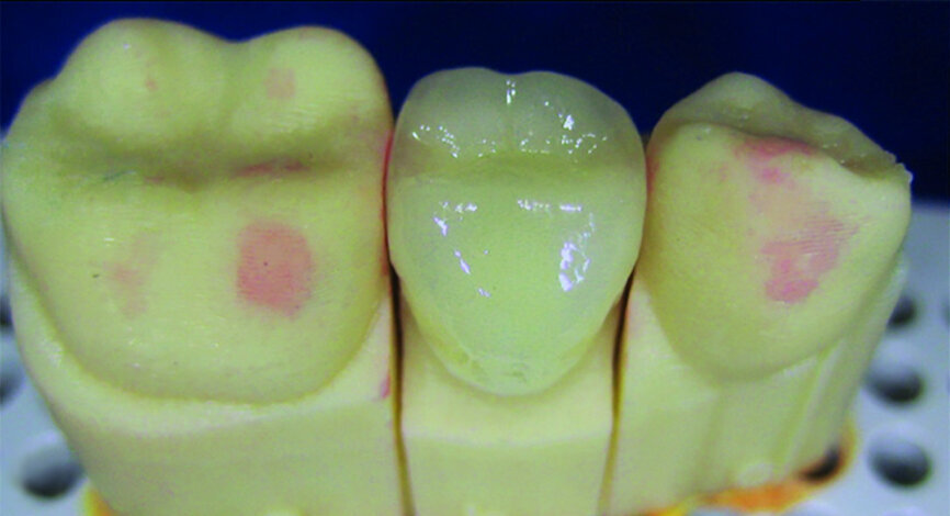 Fig. 7a: 3D printed model for fabrication of the stratified zirconia crown in the laboratory (a). Zirconia crown set in the mouth (b).