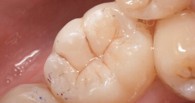 Patient-centric treatment with  composite Artistry