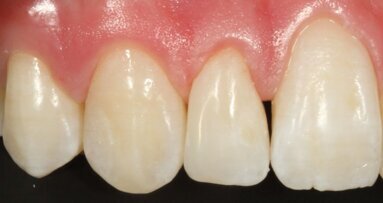 Eén composiet, één kleur voor alles?