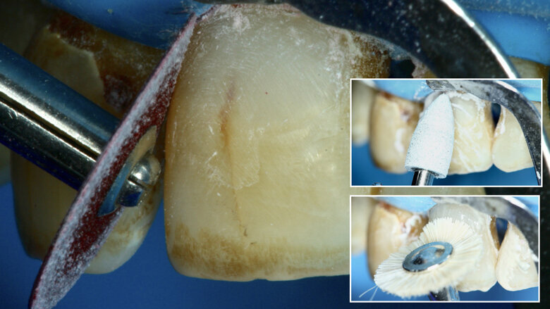 Figura 16. Se realiza el protocolo de pulido.