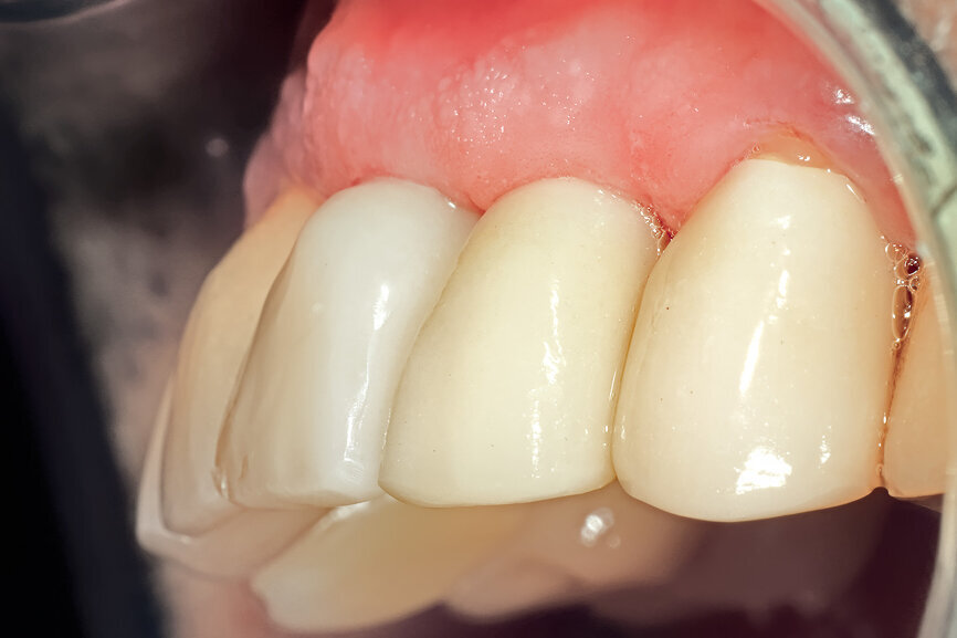 Fig. 30b: The occlusal view revealed the volume maintained with
the soft-tissue cervical contours (a), and the lateral retracted view revealed an excellent soft-tissue emergence profile (b).