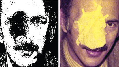 Maxillofacial prosthesis: it can happen to anyone