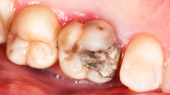 Amalgamverbot negativ für Gesundheitskosten