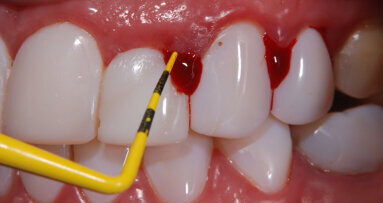 Mitos del blanqueamiento dental