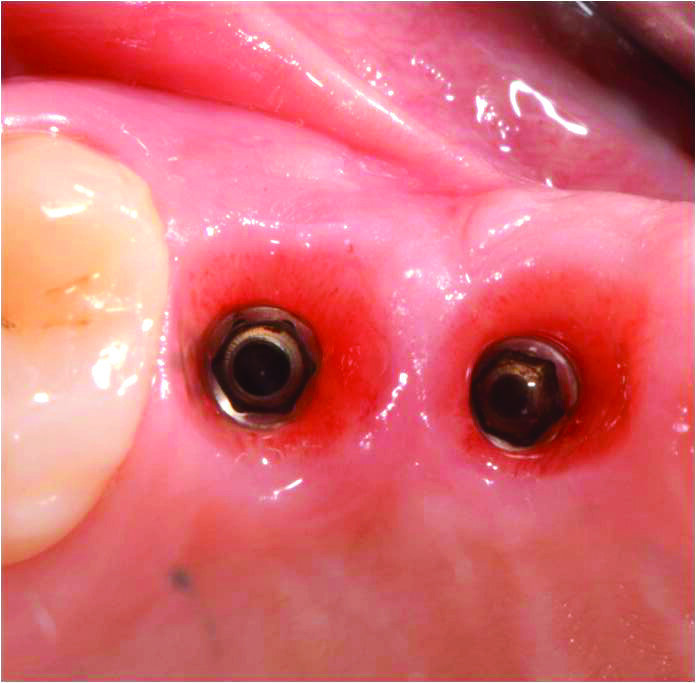 Figg. 9, 10_Dopo una fase di maturazione di 3 mesi, è stato osservato un significativo aumento del volume dei tessuti molli buccali e un miglioramento del deficit verticale dei tessuti molli.