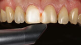 Fig. 6. Se escaneó la situación clínica con CEREC Omnicam.