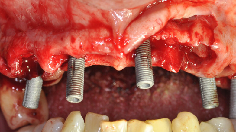 La protesi fissa a carico immediato con tecnica Flat-One-Bridge: uno studio retrospettivo a 7 anni