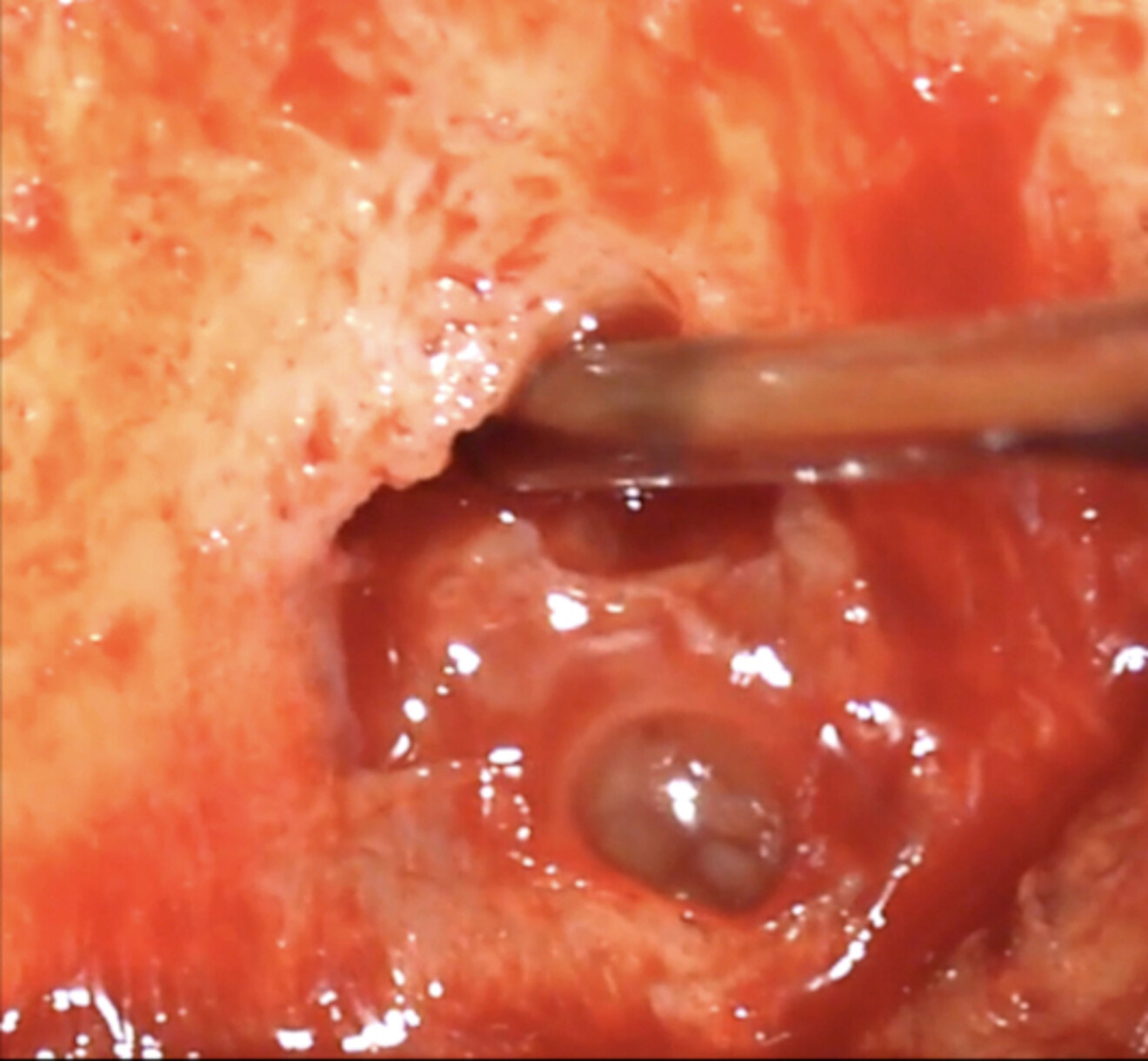 Fig. 4a: Removing the cyst from around the root without damaging the surface, followed by surface treatment of the exposed part of the root.