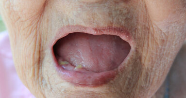 Study suggests causal link between tooth loss and heart disease