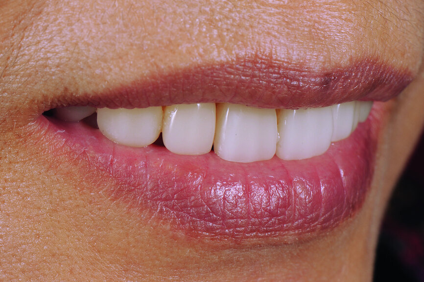 Fig. 29: Four-year follow-up: lateral view of smile.