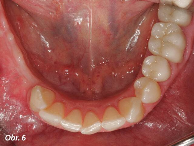 Klinická situace šest měsíců po prvním zákroku.