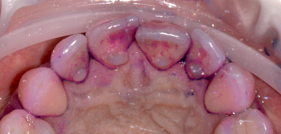 Figg. 1a-1c - Applicazione del rilevatore di placca che verrà usato come guida durante la terapia, nel versante vestibolare (1a), palatale (1b) e linguale (1c). Si noti lo scarso livello di igiene orale domiciliare e l’assenza di utilizzo dei presidi interdentali.