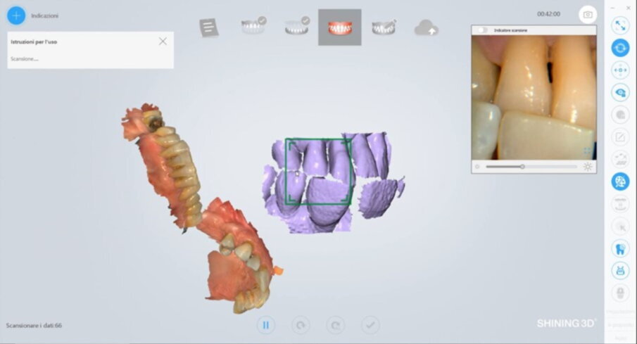 Figg. 11-12_Matching dell’arcata superiore e inferiore.