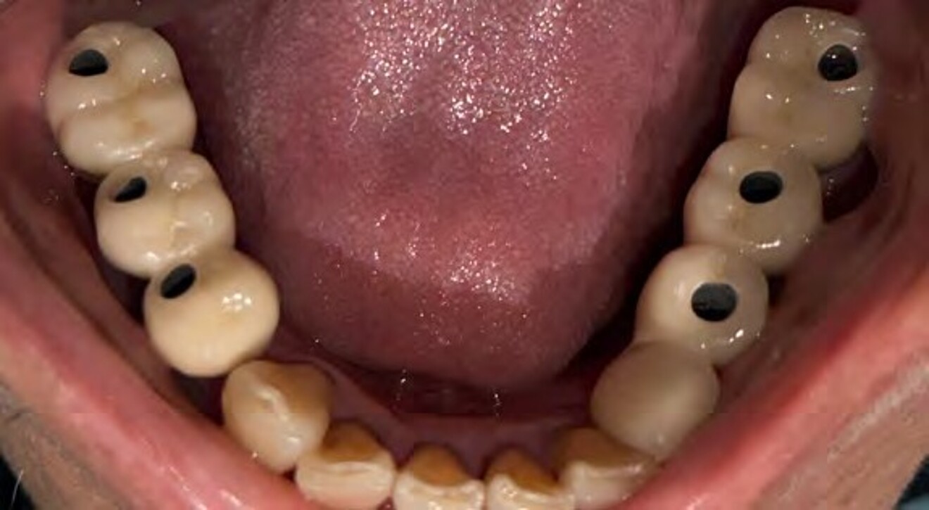 Fig. 2b: Occlusal view after exposure of the mandibular  implants and placement of healing abutments, demonstrating satisfactory peri-implant soft tissue healing.