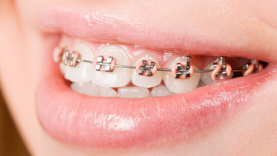 VÖK rät zu KFO-Behandlungsstart zu Beginn der Pubertät