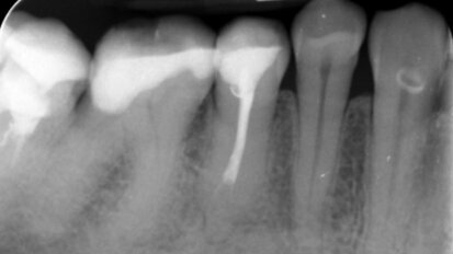 Zastosowanie lasera Er:YAG w procedurach udrażniania kanałów korzeniowych