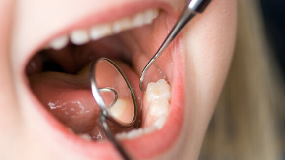 Studie belegt Wirksamkeit der parodontalen Prophylaxe