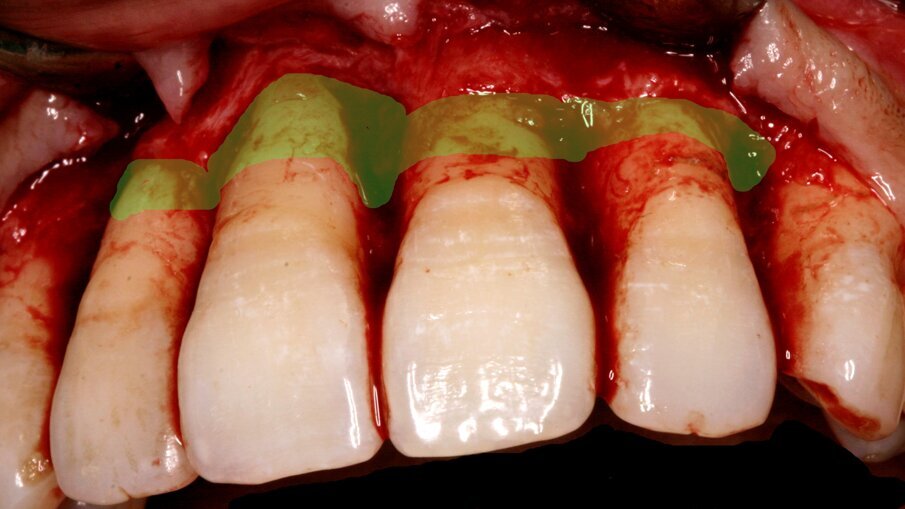 Fig. 1: Area amenable to grafting with CAPD 