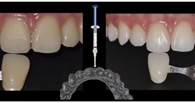 Los efectos en dientes tratados con endodoncia