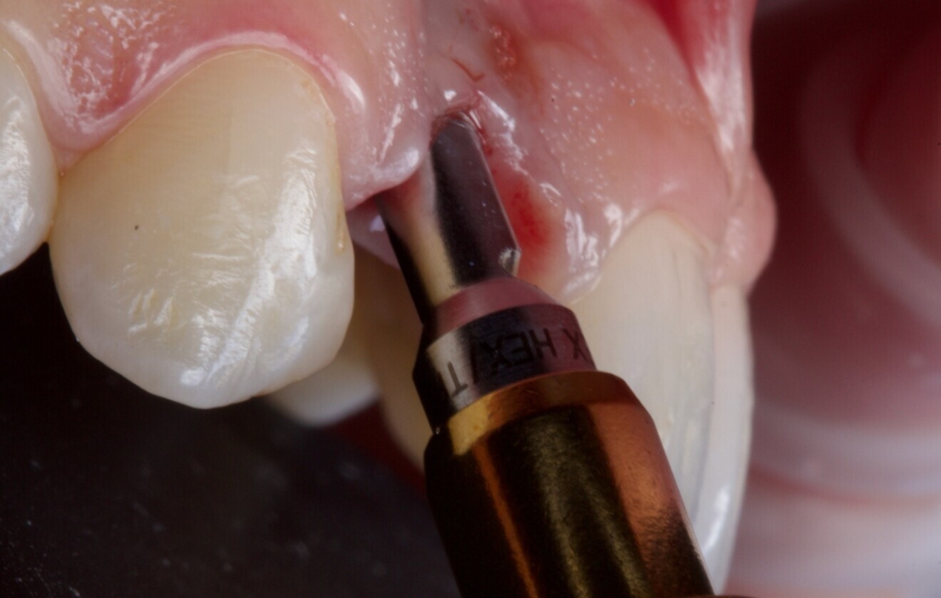 Fig. 3: Atraumatic implant removal using reverse technique.