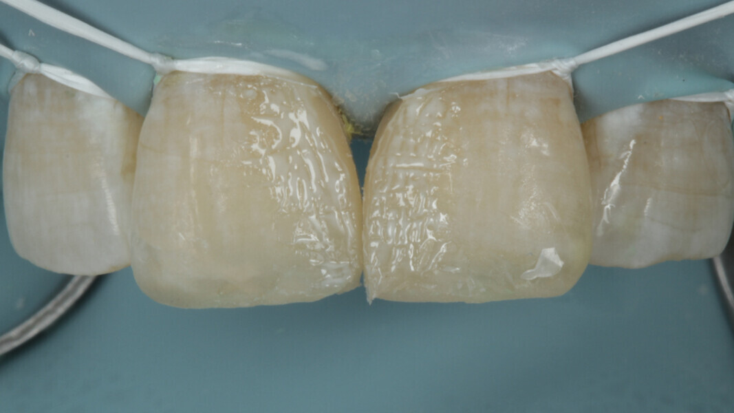 Fig 17. Finally, white opaquer is used to mimic the hypoplastic lines and light cured.