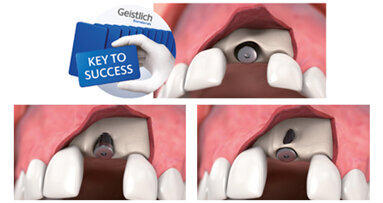 Trattamento dei difetti ossei minori:  fattori chiave per il successo