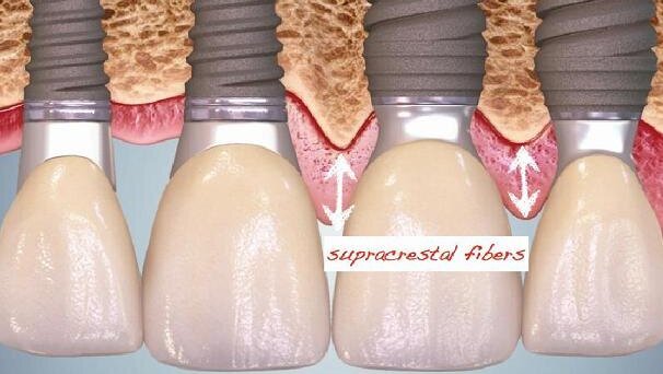 Modified clinical approach for improved aesthetics in full-arch restoration