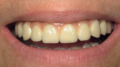 Le High Tech au service de l’implantologie