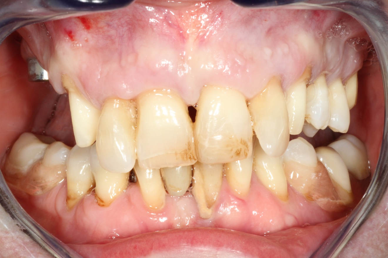 Fig. 2: Patient’s initial situation, intra-oral aspect.
