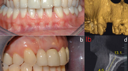 Uso di innesto osseo e membrana corticale equina per Guided Bone Regeneration nella zona estetica