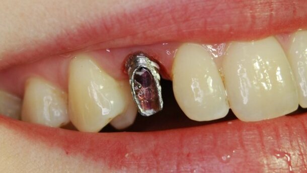 Wpływ czynników estetycznych na wybór metody rehabilitacji implantoprotetycznej