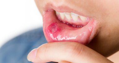 Un nouveau traitement contre les ulcères aphteux fera l'objet d'un essai clinique en Suède