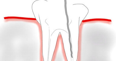 Ultrasoon reinigen zorgt voor schoner wortelkanaal