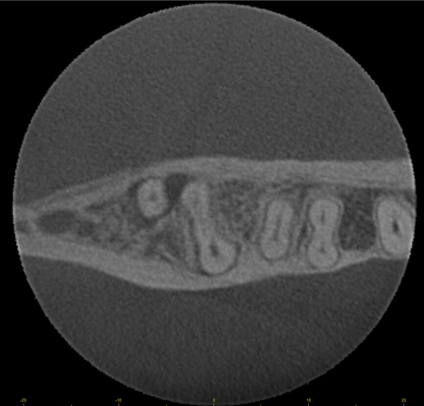 Fig. 15d: Cased treated with PIPs (Photon Induced Photoacoustic Streaming). Note the orifice barrier placed in composite to protect the endodontic treatment from coronal leakage. (Courtesy of Dr. Paula Elmi)