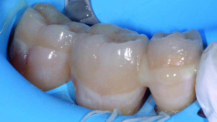 Fig. 15 :
Avant polymérisation flash, application de la colle Variolink Esthetic DC. 