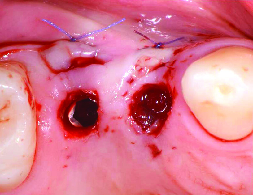 Fig. 6_Il connettivo prelevato dalla cresta è stato inserito e stabilizzato mediante sutura riassorbibile nelle due tasche, realizzate nella mucosa al lato dei siti implantari.